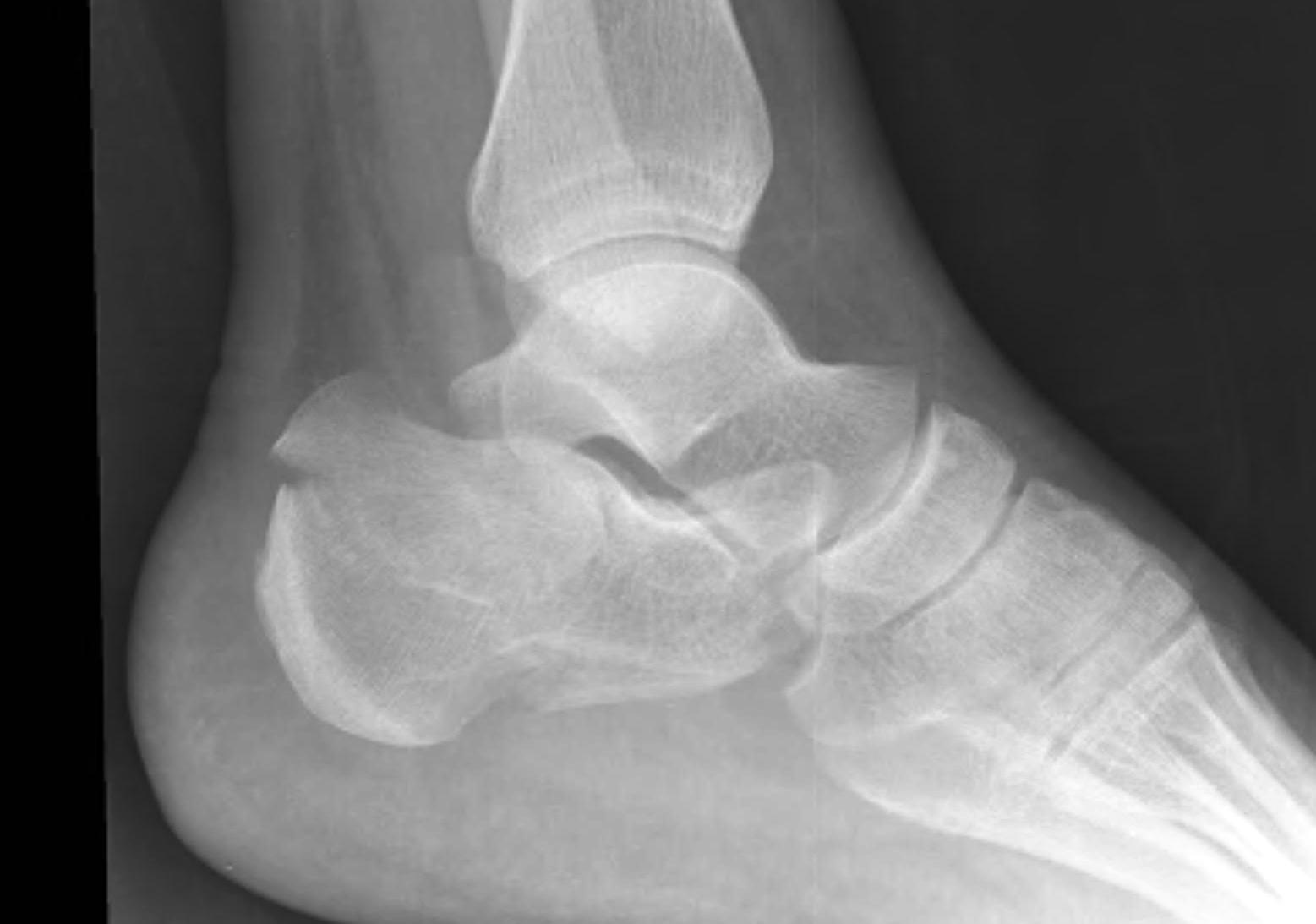 Calcaneum Tuberosity Fracture